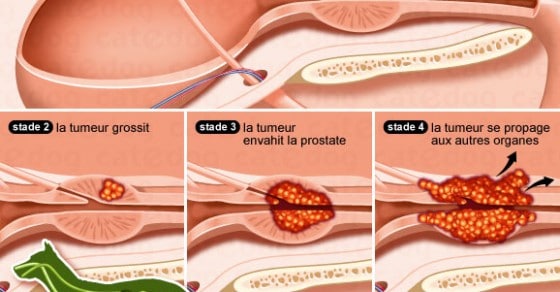 capsula prostatei de ce un barbat are prostatita