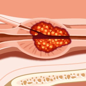 fares prostate capsule semne de prostatita cronică și tratament