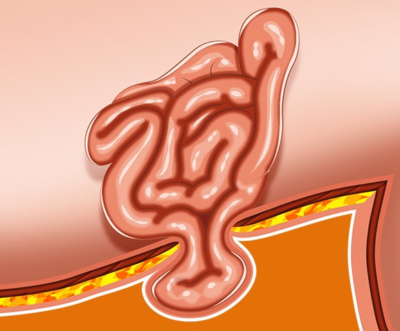 Occlusion intestinale chez le chat et hernie ombilicale