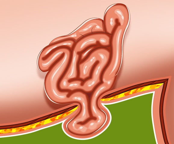 Occlusion intestinale chez le chien et hernie ombilicale