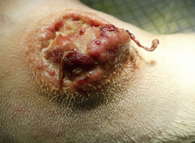 Tumeur mastocytome cutané chez le chien