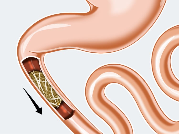 Occlusion intestinale par une boule de poils chez le chat