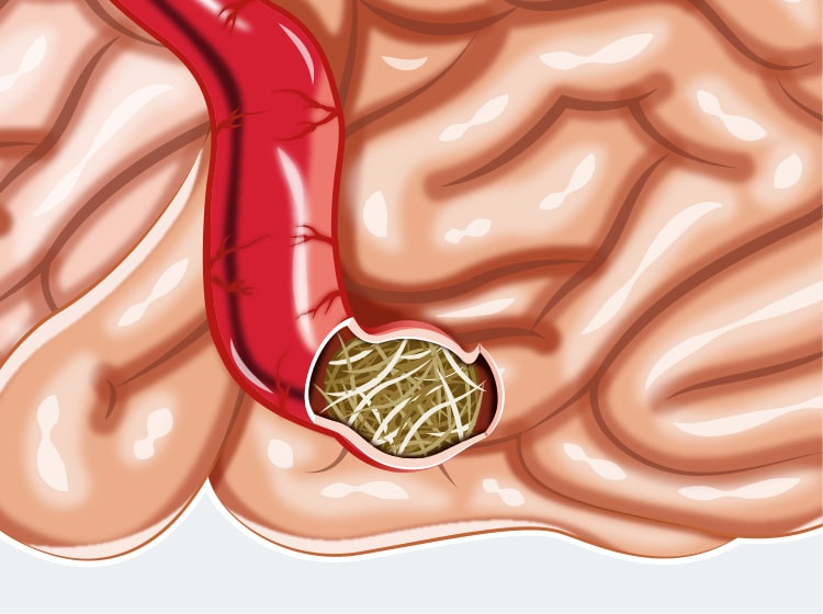 Occlusion intestinale par une boule de poils chez le chat