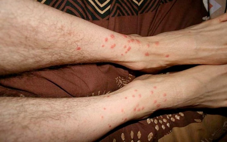 Piqures de larves d'aoûtats sur les jambes d'un homme