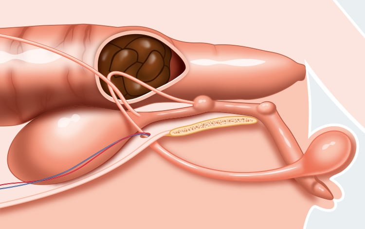Occlusion intestinale due à une constipation aboutissant à une coprostate et la formation d'un fécalome chez le chat