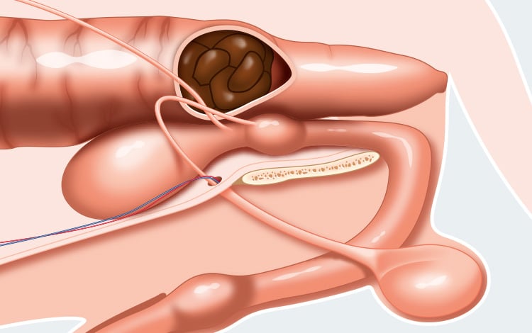 Occlusion intestinale due à une constipation aboutissant à une coprostate et la formation d'un fécalome chez le chien