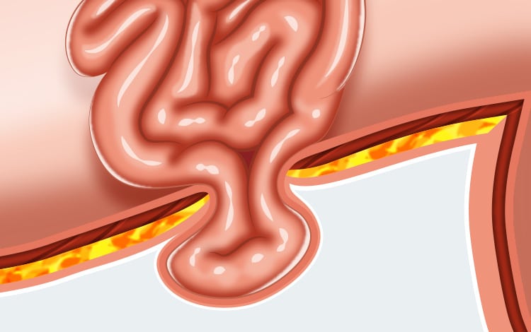Occlusion intestinale due à une hernie ombilicale chez le chien et le chat