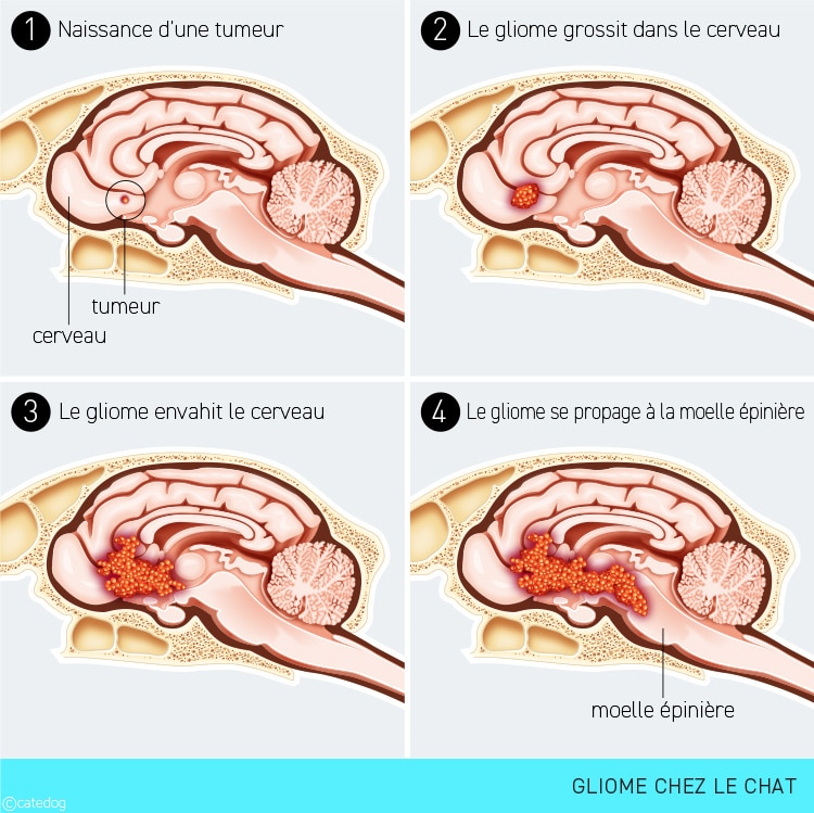 Stades de la tumeur gliome dans le cerveau du chat