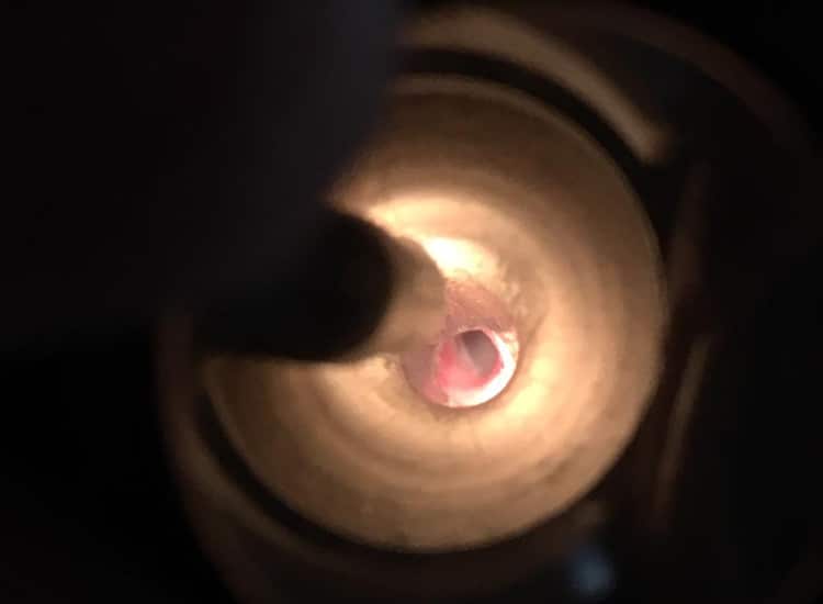 Examen du conduit auditif à l’aide d’un endoscope, permettant de visualiser une inflammation du conduit auditf