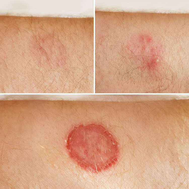 Stades de la teigne sur la peau de l'homme