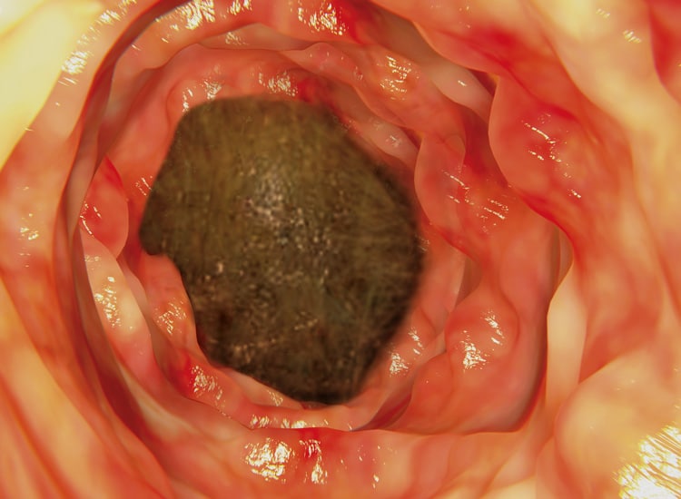 Boule de poils coincée dans l’intestin d’un chat provoquant une occlusion intestinale